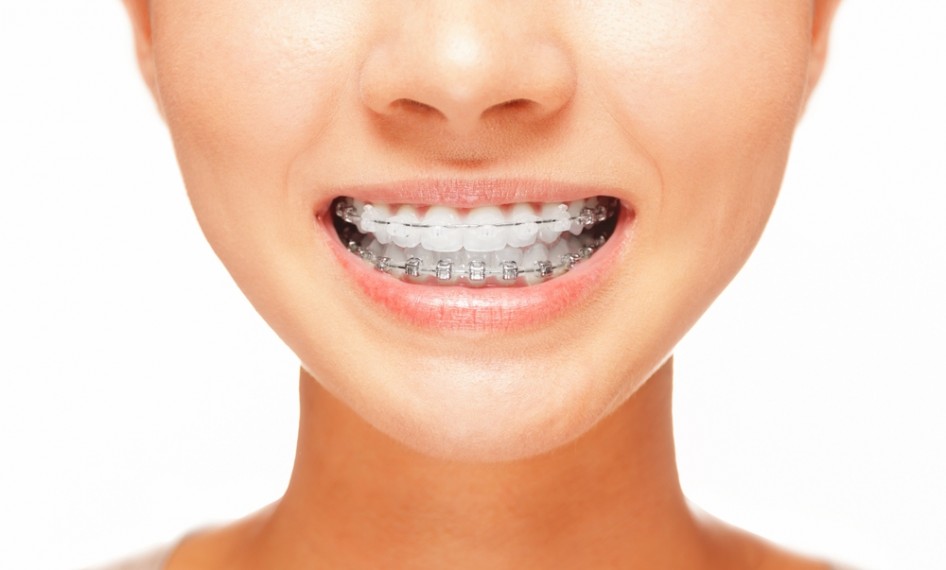 braces.  Ortodoncia, Famosos, Brackets